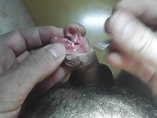 穿刺和subincision